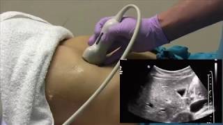 How I do it Ultrasound of the Abdomen [upl. by Nanaek62]