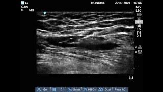 Blokada przedziału powięzi biodrowej Fascia iliaca compartment block [upl. by Adnek]