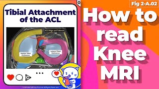 Fig 2A02 Tibial attachment of the ACL ACL footprint [upl. by Sineray726]