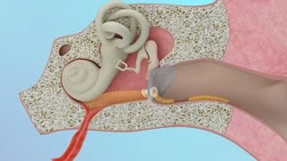 Clogged Ear Due to Ear Infection or Eustachian Tube Dysfunction [upl. by Annaul]