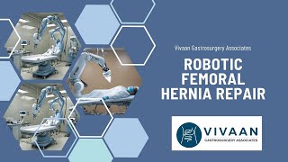 Robotic Femoral Hernia Repair  Minimally edited  Robotic Surgery  Dr Suril Vithalani [upl. by Yuhas]