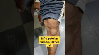 Infra patellar bursitisknee pain kneepain drsaichandra [upl. by Ttsepmet263]