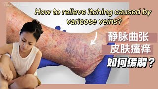 如何缓解静脉曲张引起的皮肤瘙痒？How to relieve itching caused by varicose vein？ [upl. by Bari]