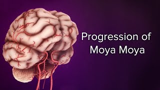 Medical Animation Progression of Moyamoya  Cincinnati Childrens Cerebrovascular Center [upl. by Garald]