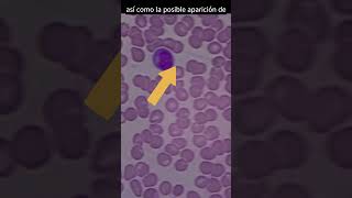 Así se ve la sangre infectada con DENGUE analisisclinicos dengue virusdeldengue [upl. by Grim677]