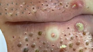 Big Cystic Acne Blackheads Extraction Blackheads amp Milia Whiteheads Removal Pimple Popping  703 [upl. by Nnylyahs129]