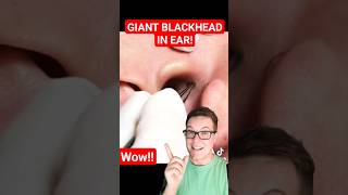 Giant BLACKHEAD REMOVAL FROM EAR  The Biggest I Have Seen shorts [upl. by Eelsha389]