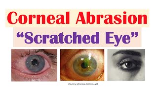 Corneal Abrasion “Scratched Eye”  Causes Signs amp Symptoms Diagnosis Treatment [upl. by Anyek830]