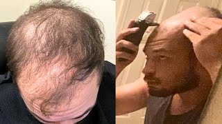 SHAVING My Head BALD Started BALDING at 16 [upl. by Llertnor]