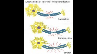 Peripheral nerve injuries classification and Wallerian degeneration [upl. by Anahcar]