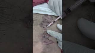 Best Keloid Treatment in Jaipur SkinaaClinic viral shorts [upl. by Vez40]