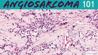 Angiosarcoma 101 for Pathologists and Dermatologists [upl. by Timothy440]