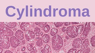 Cylindroma  Pathology mini tutorials [upl. by Ennayr]