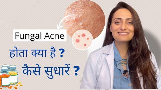 Fungal acne kya hota hai  kaise control kare  Tvacha ke doctor  Dr Aanchal Panth [upl. by Yrehcaz]