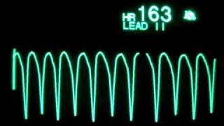 Ventricular Tachycardia [upl. by Allehc]