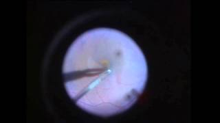 Chirurgie du trou maculaire Stage 3  Macular hole surgery Stage 3 [upl. by Verile]