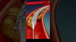 हार्ट के ब्लॉकेज का रामबाण इलाज Heart Angioplasty Explained in 3D Animation [upl. by Alcus]