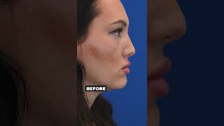 Filler Dissolving and Midface rejuvenation microneedling fattransfer fillerdissolving morpheus8 [upl. by Isolde]