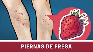 Puntos Negros o Piernas de Fresa  Aprende Remedios Caseros [upl. by Buell]