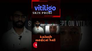 Vitiligo fact Nepali 2024 [upl. by Erehs]