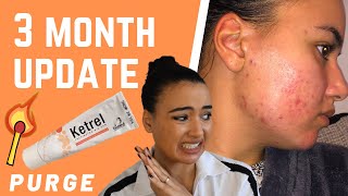 MY SKIN IS WORSE 😩 TRETINOIN CREAM PURGE  3 MONTH UPDATE [upl. by Anivek]