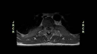 Cord Compression due to Extramedullary Hematopoiesis in an Adolescent with Beta Thalassemia Major [upl. by Enirrok]