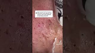 Cystic Acne Removal amp Inflammatory Acne [upl. by Emma]