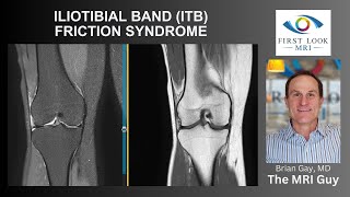 ILIOTIBIAL BAND ITB FRICTION SYNDROME [upl. by Bunder320]