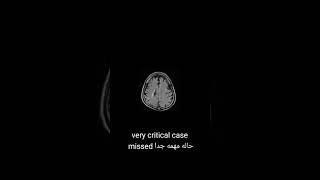 Very important case Radiology skull base with carotid and jugular occlusion critical emergency [upl. by Ynned]