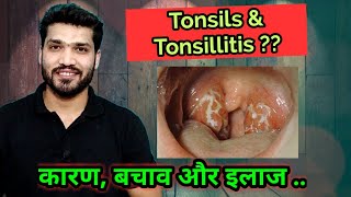 What is tonsillitis  Prevention amp treatment [upl. by Fein588]