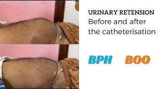 DISTENDED BLADDER  AFTER CATHETERISATION [upl. by Drawe]