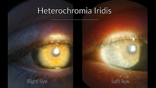 Fuchs Heterochromic Iridocyclitis  Ophthalmology cases [upl. by Atiuqrehs]