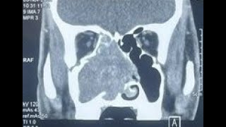 Cách lấy u máu thể hang Cavernous hemangioma on the right nasal cavity [upl. by Ennayelhsa]