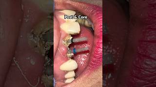 Post and Core Dental  Zirconia Crown Cementation  Anterior Post amp Core Build Up  Zirconia Crowns [upl. by Corvin]