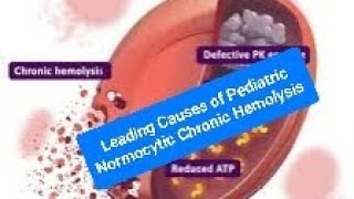 Leading Causes of Pediatric Normocytic Chronic Hemolysis G6PD and PKD [upl. by Evannia278]