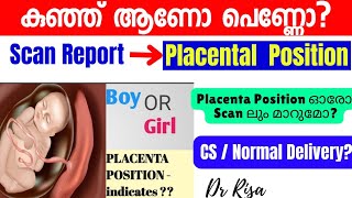 Gender Prediction Malayalam Anterior Placental Boy Girl കുഞ്ഞ് ആണോ പെണ്ണോ [upl. by Latona]