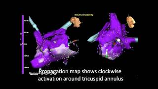 Atrial Flutter ablation  atypical clockwise [upl. by Tab71]