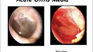 Acute and Chronic Otitis media Cholesteatoma Mastoiditis and Otosclerosis [upl. by Othelia]