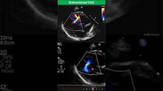 Bidirectional Ventricular Septal Defect Early Stage of Eisenmenger Syndrome [upl. by Eceinahs205]