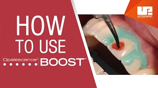 How to Mix and Apply Opalescence™ Boost™ InOffice Medical Tooth Whitening [upl. by Glaser]