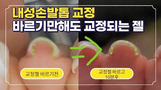 내성발톱교정 젤 바르기만해도 펴진다고 아싸젤 제가직접 써봤습니다 [upl. by Noitsuj]