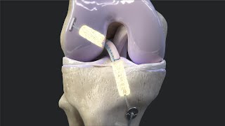 Arthrex BioACL™ Technique [upl. by Ahsila]