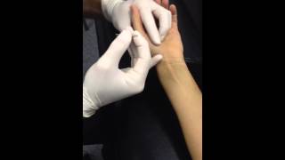 Opponens Pollicis Dry Needling [upl. by Luebke]