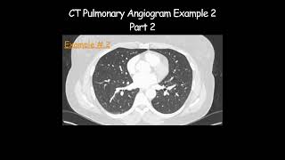 CT Pulmonary Angiogram  Example 2  Part 2 radiologist radiology angiogram artefact [upl. by Morven761]