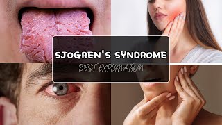 Sjogrens Syndrome Etiology Clinical Features Diagnosis and Treatment [upl. by Ttereve]