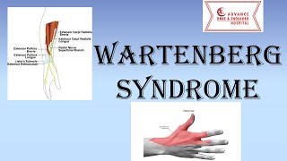 Wartenberg Syndrome  Superficial Radial Nerve Compression Neuropathy [upl. by Zetra]