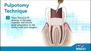 TheraCal PT Whiteboard Video  Discover Our Pulpotomy Treatment [upl. by Barty]