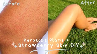 GET RID OF STRAWBERRY LEGS  KERATOSIS PILARIS  DARK SPOT REMOVAL My At Home Remedy Cure  DIY [upl. by Luap]