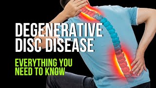 Degenerative Disc Disease  Everything You Need to Know [upl. by Iramohs]