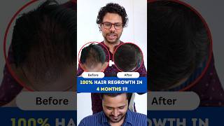 100 Hair Regrowth in 4 Months  Hair Loss  Hair Regrowth  Hair Fall  Adon Hair Care viral [upl. by Favata]